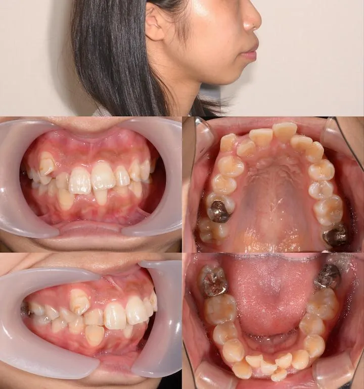 上下顎前突の治療例 - 術前術後比較 1