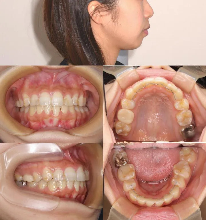 上下顎前突の治療例 - 術前術後比較 2