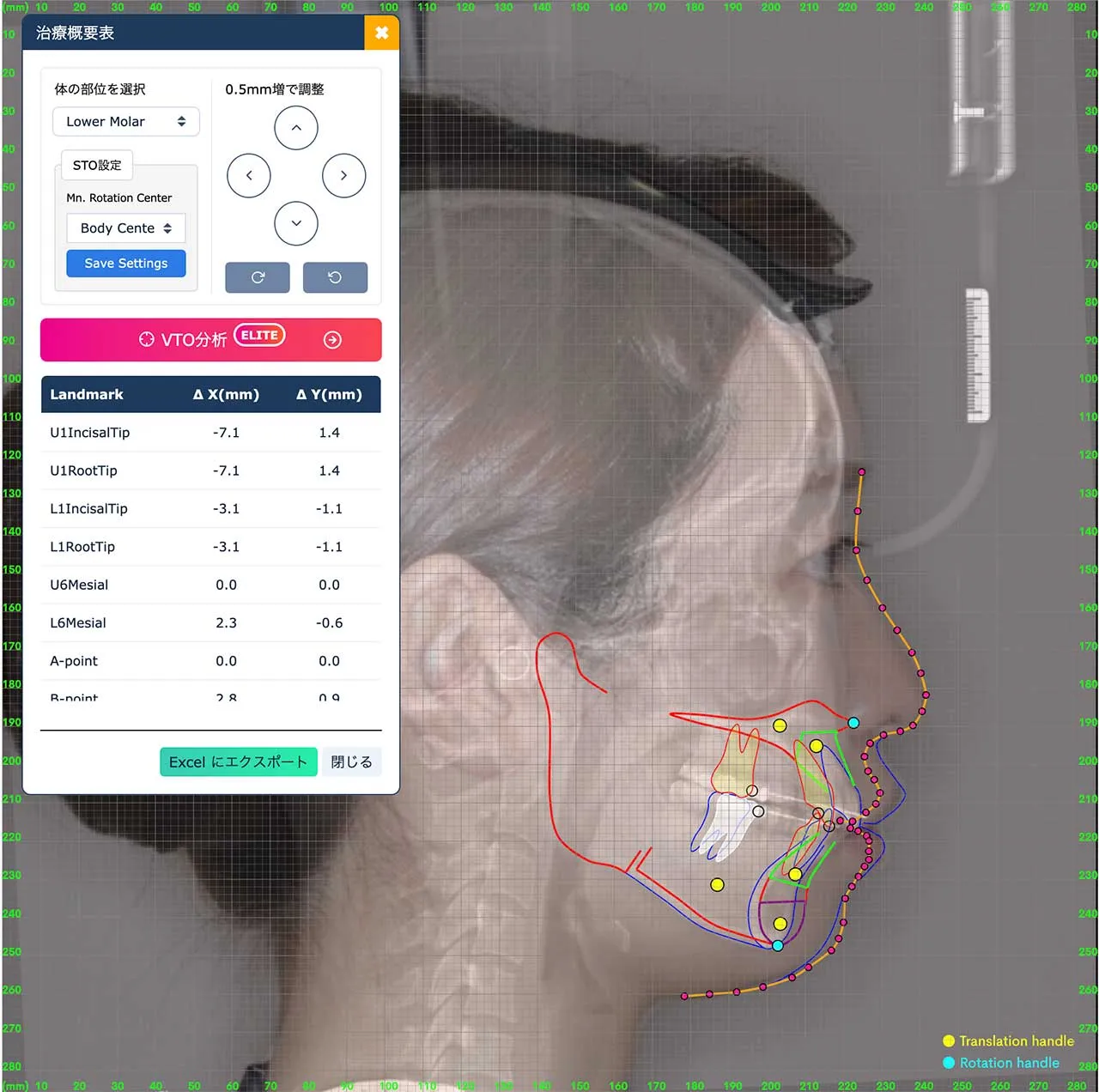 抜歯矯正による横顔の変化