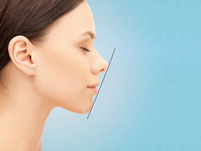 横顔 (Eライン) の改善イメージ