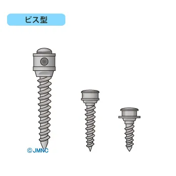 アンカースクリューを併用した高度な治療