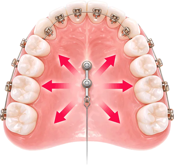 i-stationによる360度牽引の方向を示す模式図