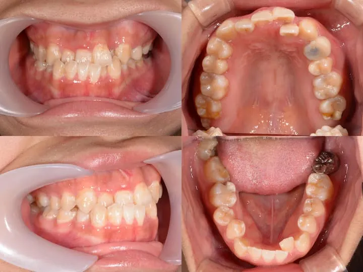 下顎前突の治療例 - 治療前