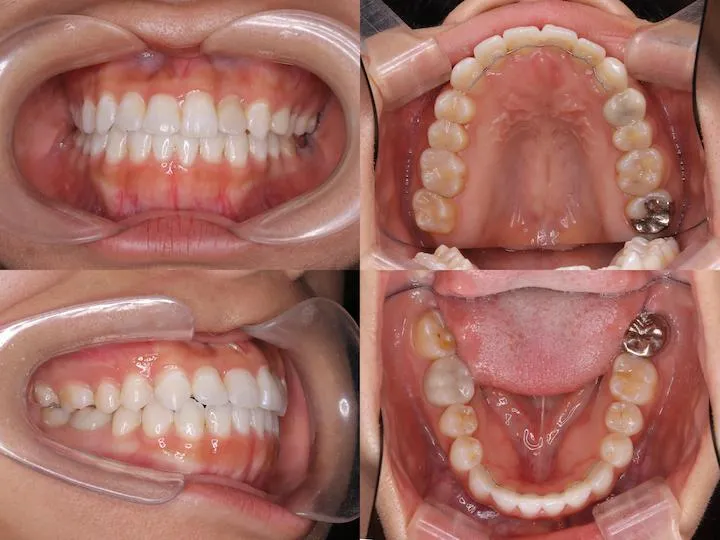 下顎前突の治療例 - 治療後