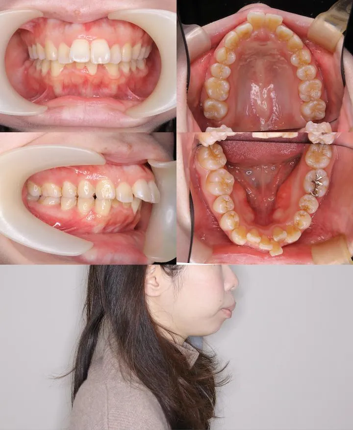 上顎前突の治療例 - 術前術後比較 1