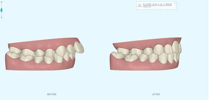 アウトカムシミュレーション - 矯正治療後の歯並びを治療前に確認
