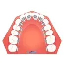 02_07lingual_braket01