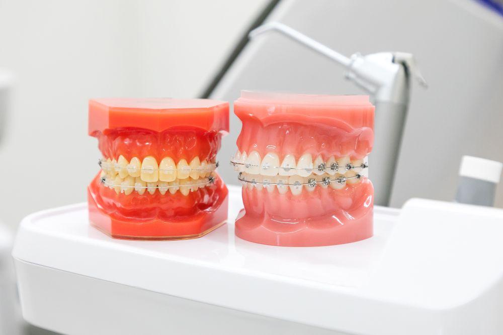 2種類のワイヤー矯正をしている歯の模型